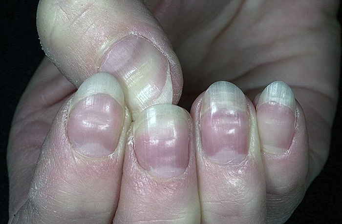 Почему ногти становятся ребристыми? Способы лечения