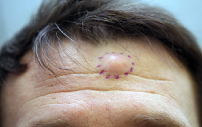 Жировики на лице: профилактика образований и способы их устранения